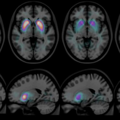Qu’est-ce que la hernie des amygdales cérébelleuses (malformation de Chiari) et comment est-elle traitée ?