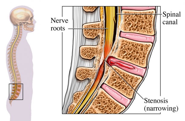 Spinal-Stenosis Sténose du canal rachidien