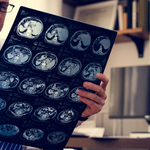 Selle turcique vide (Empty Sella)