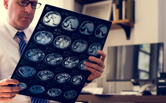 Selle turcique vide (Empty Sella)