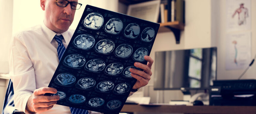 empty_sella Selle turcique vide (Empty Sella)